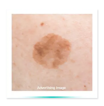 Frackles-solar-lentigo