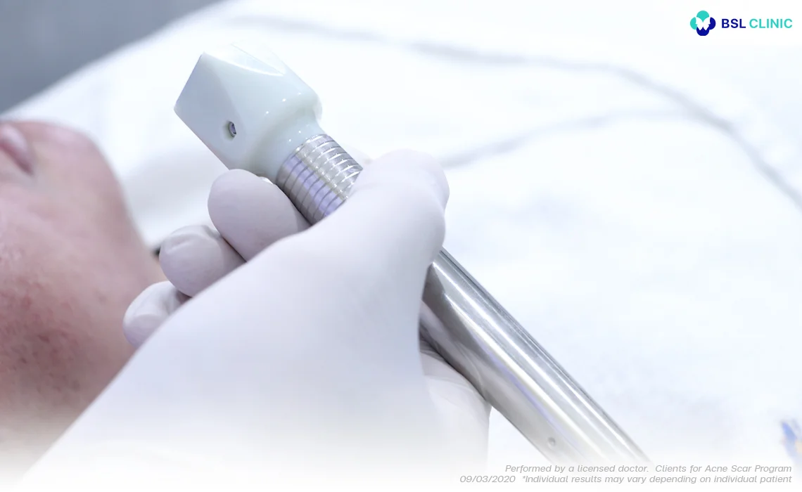 How it works Fractora Resurfacing Laser