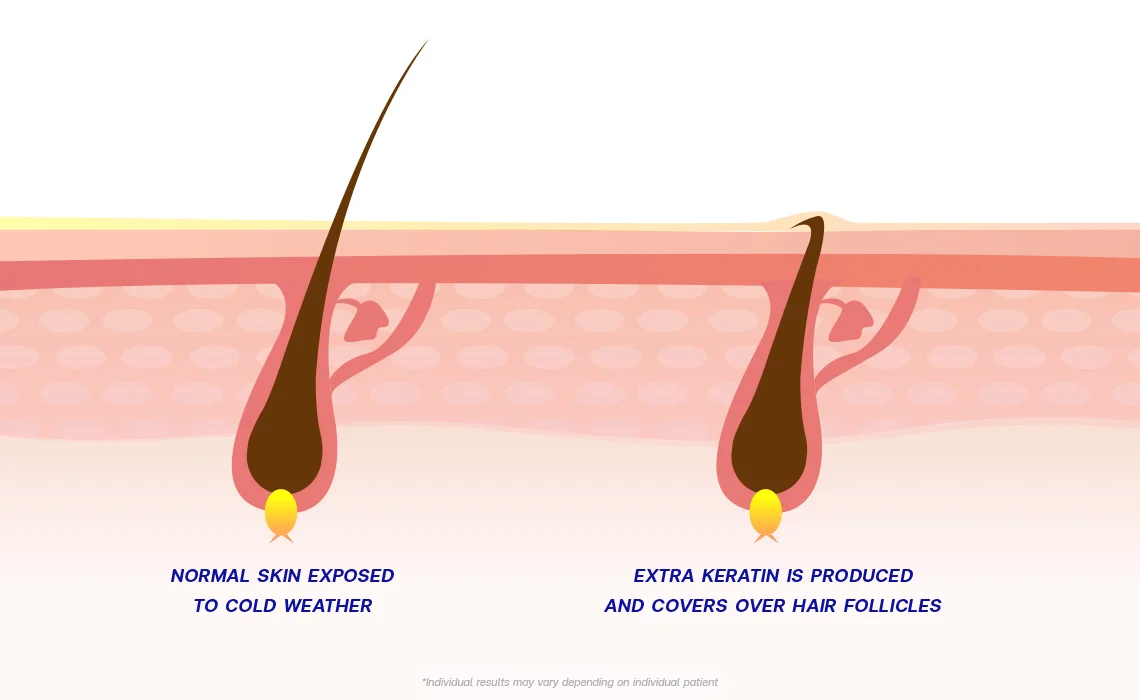 Keratosis Pilaris and Pseudo Folliculitis