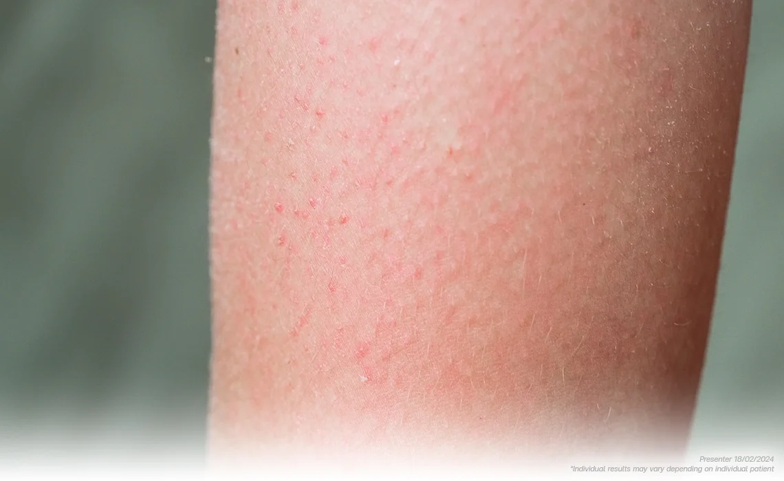 Keratosis Pilaris