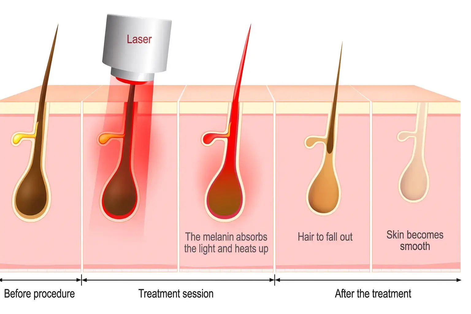 laser hair removal bangkok hair removal treatment cutera coolglide ipl hair removal clinic bangkok thailand light based program