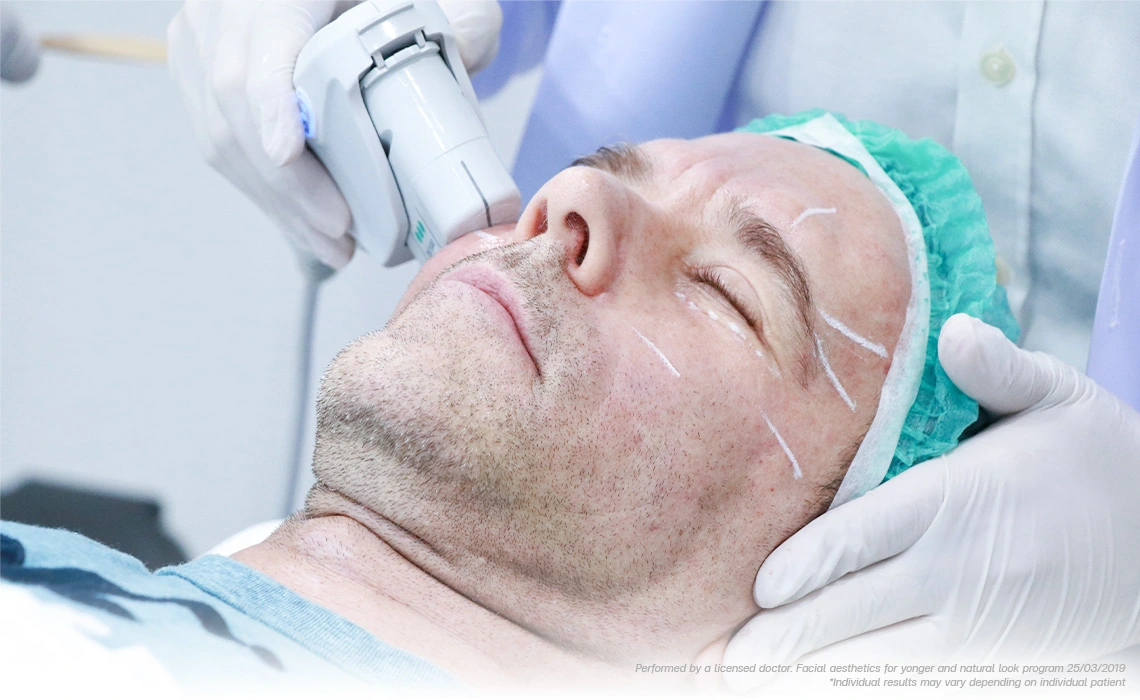 ultherapy face lift for sagging jawline and neck rejuvenation after 60