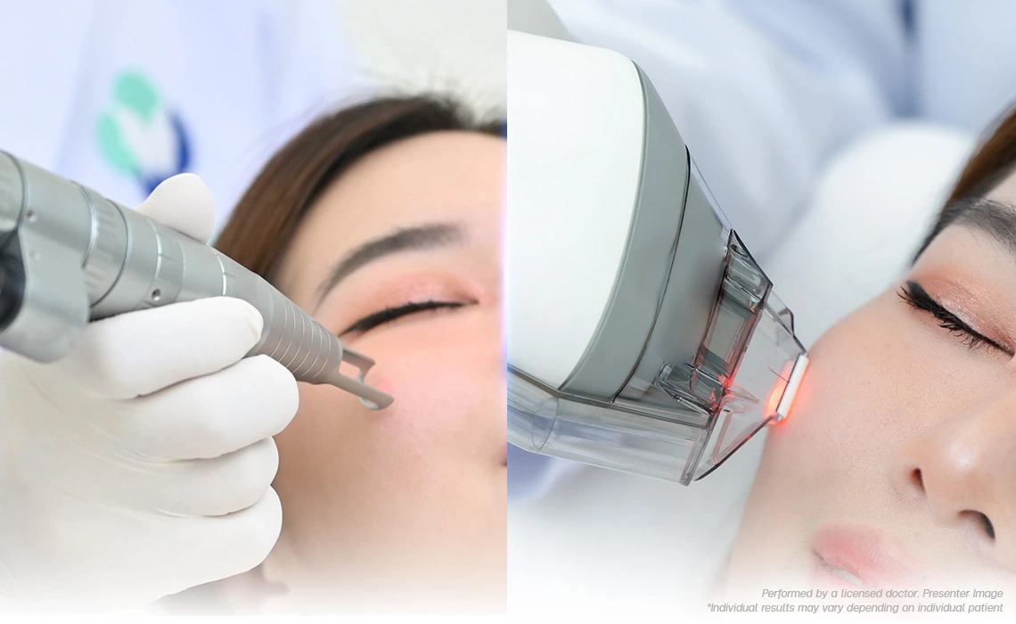 Melasma Fraxel laser pigment removal laser