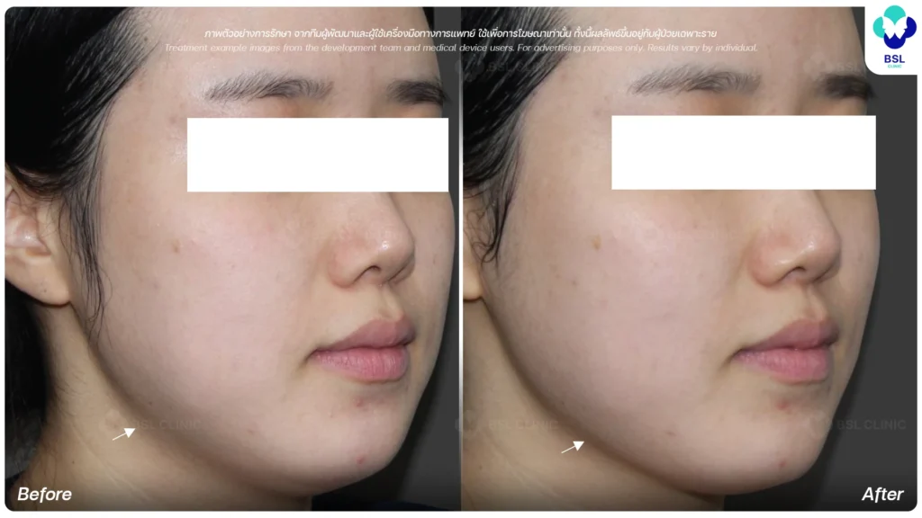รีวิวผลลัพธ์การทำ OligioX Program
