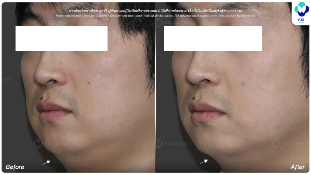 รีวิวผลลัพธ์การทำ OligioX Program