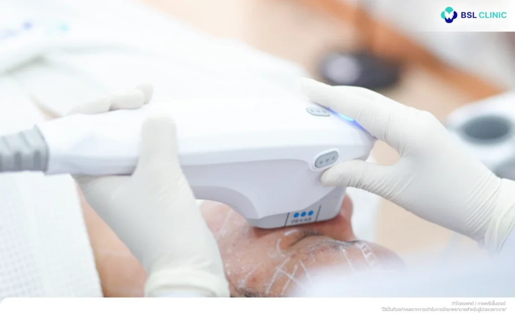 OligioX + Ulthera Prime Program ยกกระชับลึก เก็บผิวชั้นบน