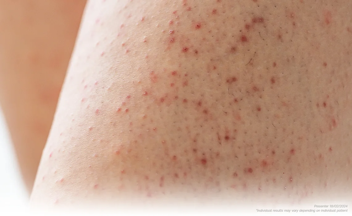 Pseudo folliculitis​