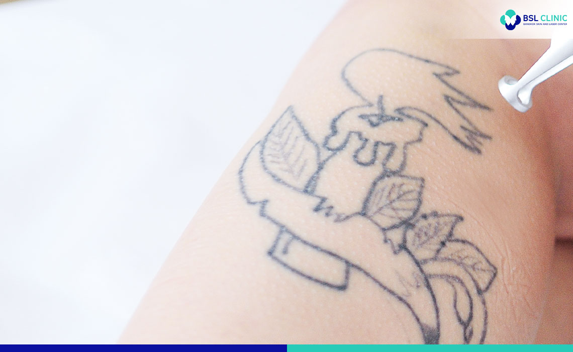 Q Switched Ruby Laser removes the tattoo