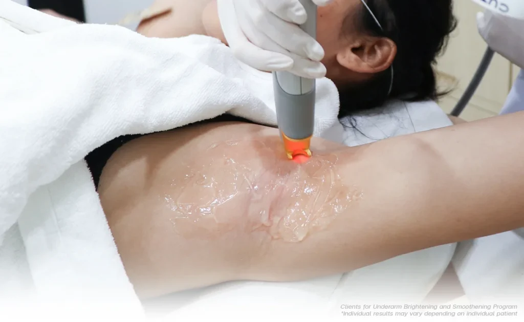 REMOVE UNDERARM HAIR WITH LASER