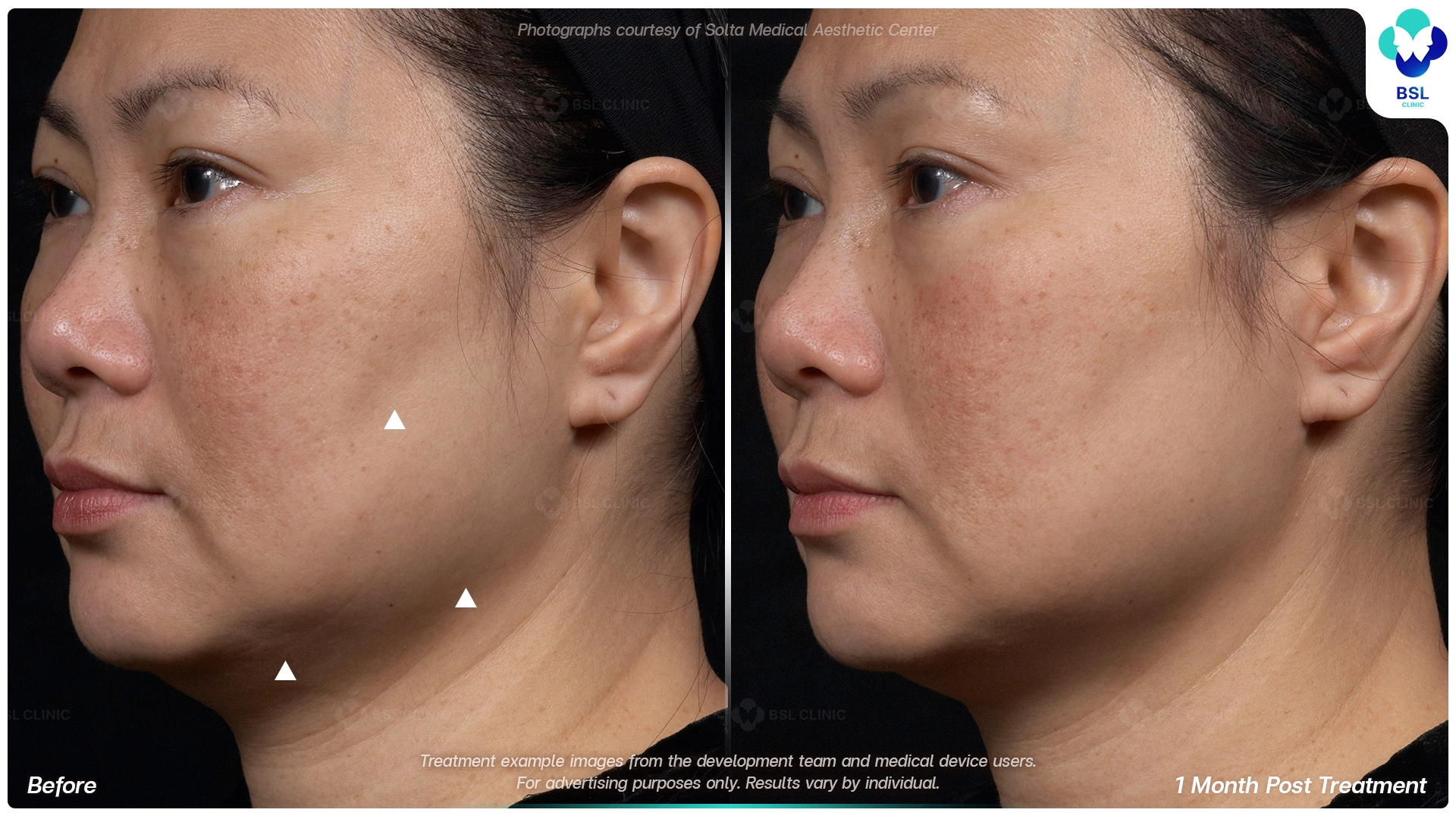 result before after Thermage younger
