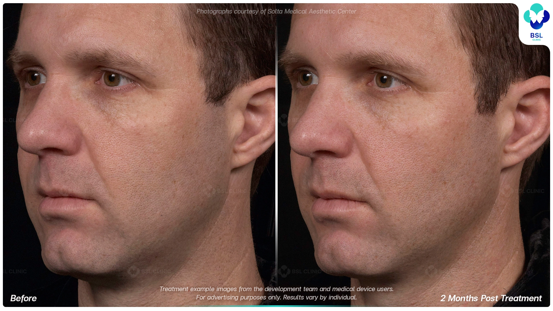 result before after Thermage younger