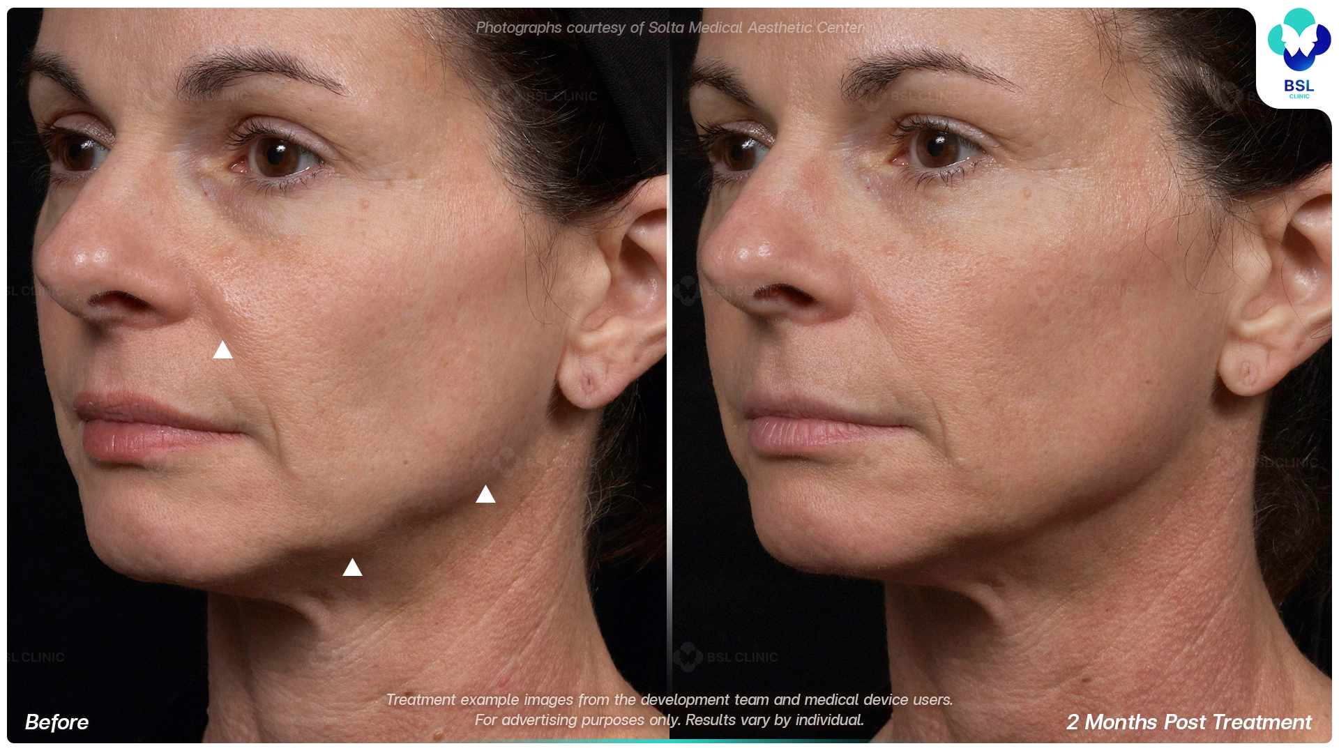 result before after Thermage younger