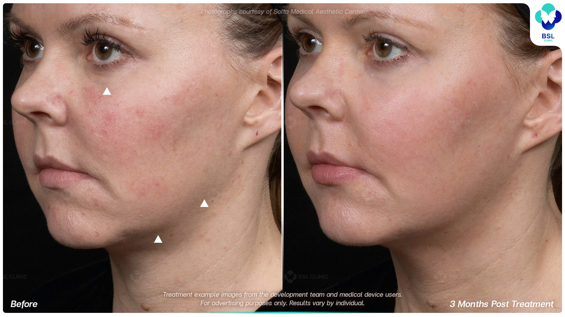 result before after Thermage younger