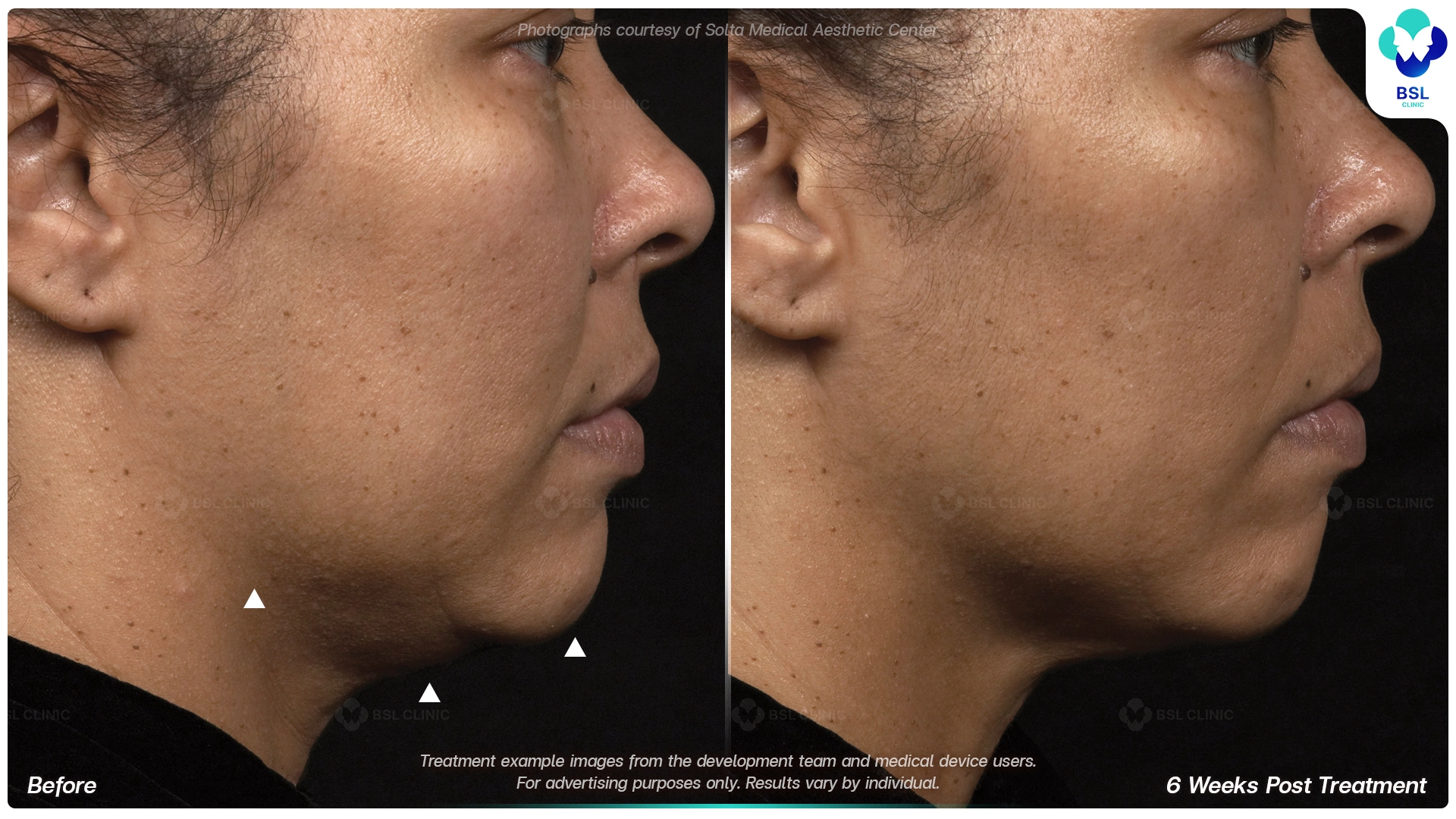 result before after Thermage younger