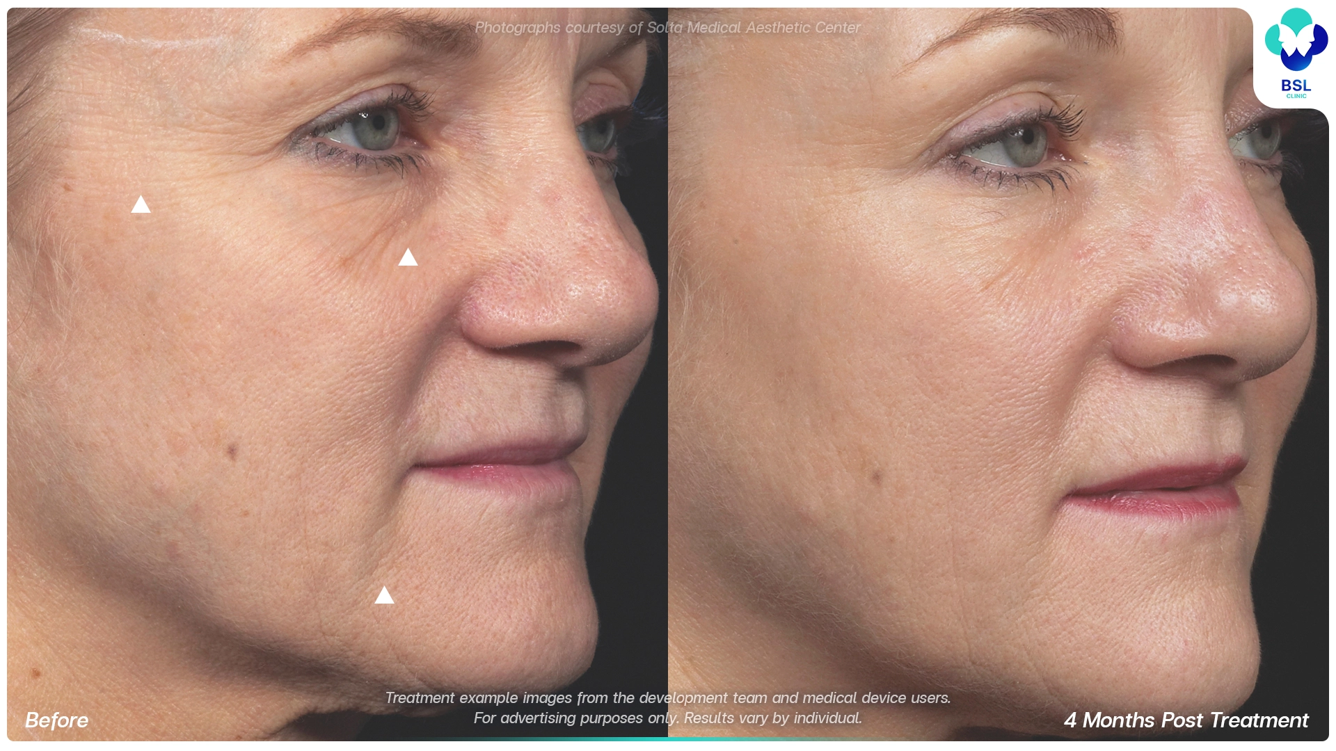 result before after Thermage younger