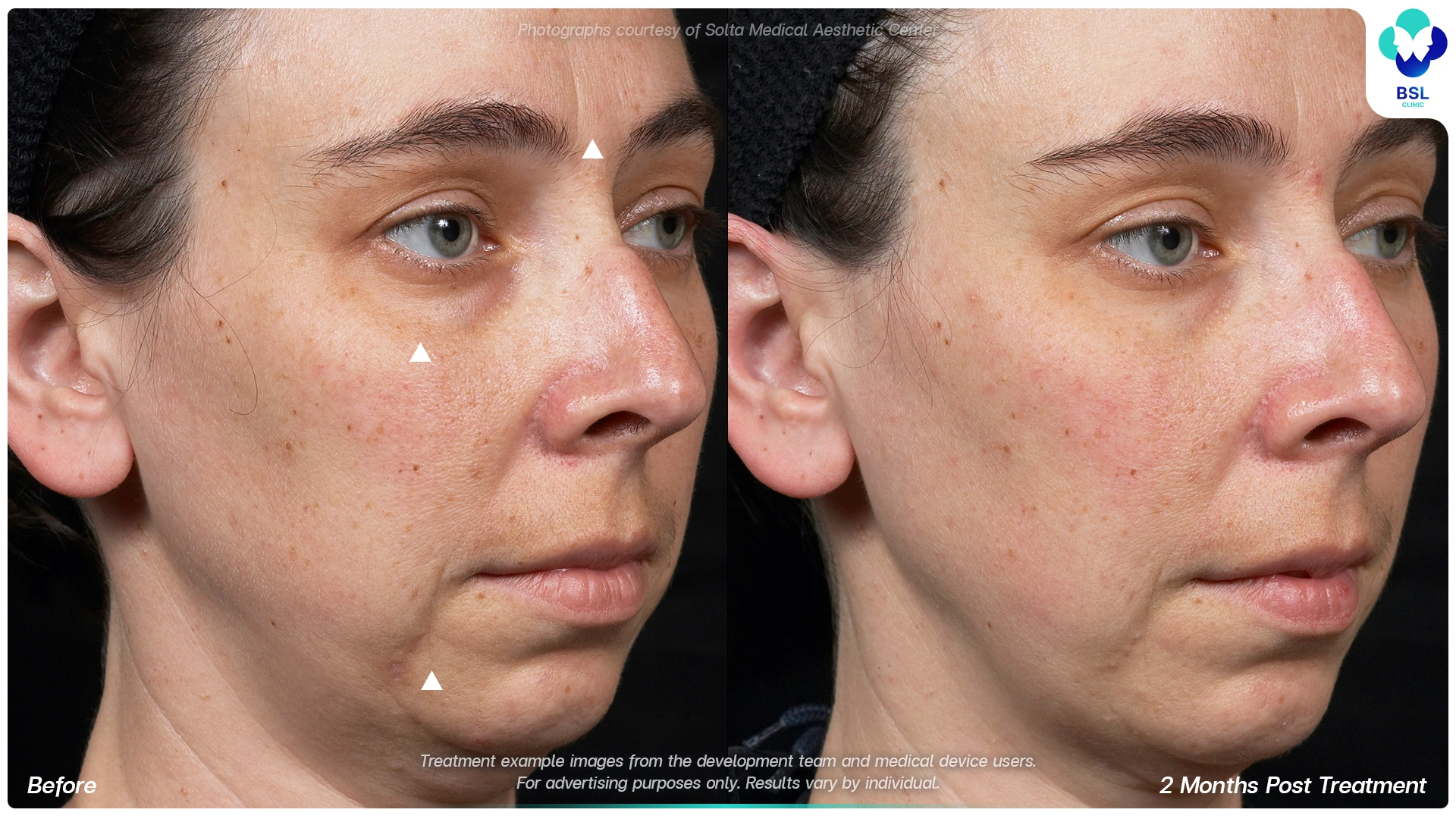 result before after Thermage younger