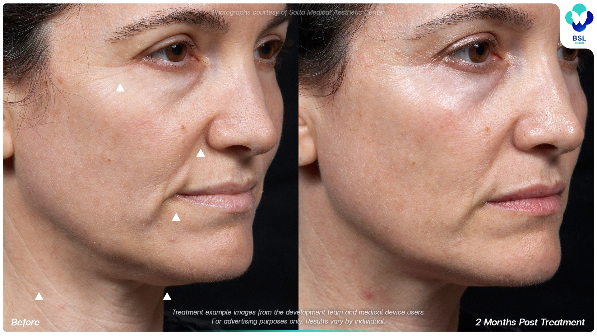 result before after Thermage younger