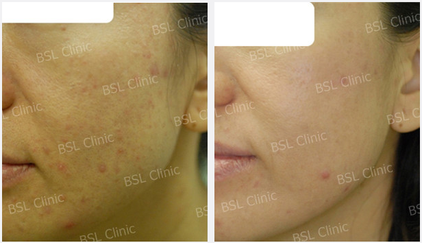 Galleries Acne Cure & Treatment, Acne Scar, Acne Blemish