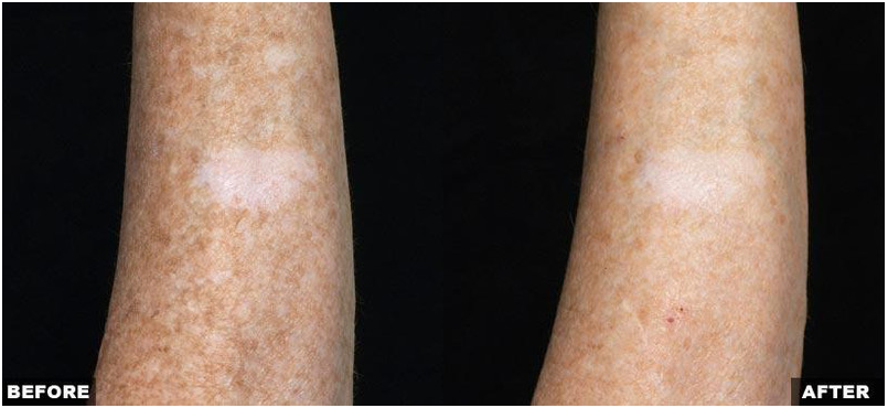 Resurfacing Laser Fraxel Dual program
