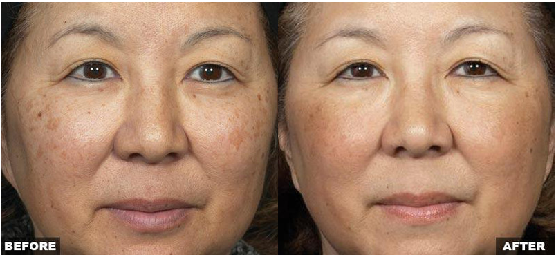 Resurfacing Laser Fraxel Dual program
