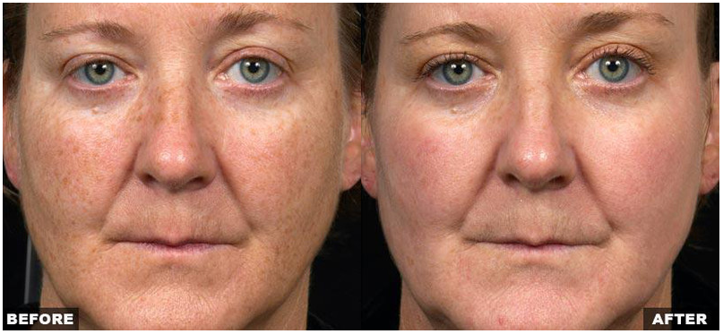 Resurfacing Laser Fraxel Dual program