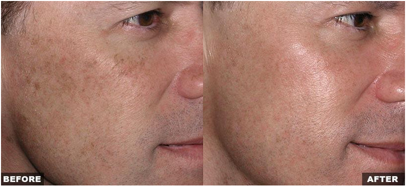 Resurfacing Laser Fraxel Dual program