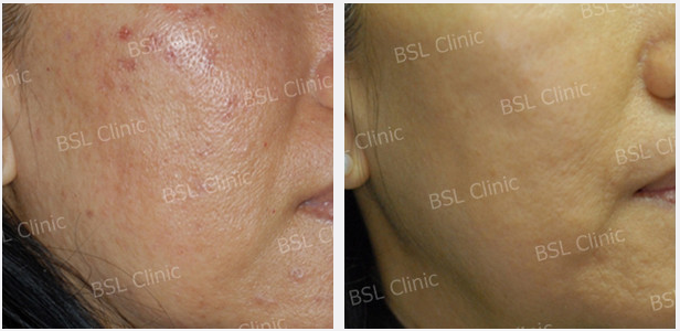 Galleries Acne Cure & Treatment, Acne Scar, Acne Blemish