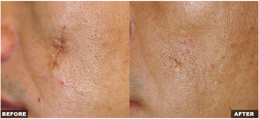 Resurfacing Laser Fraxel Dual program