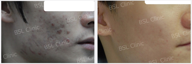 Galleries Acne Cure & Treatment, Acne Scar, Acne Blemish