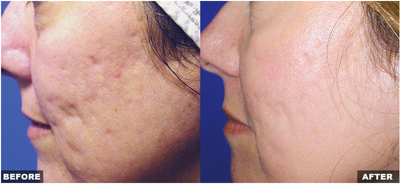 Resurfacing Laser Fraxel Dual program