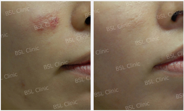 Galleries Acne Cure & Treatment, Acne Scar, Acne Blemish