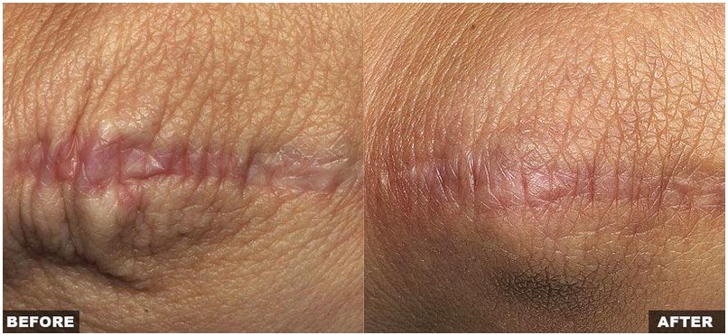 Resurfacing Laser Fraxel Dual program