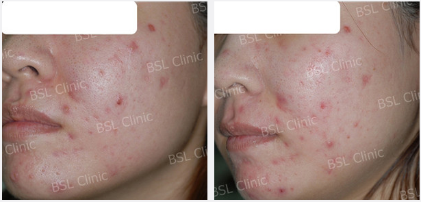 Galleries Acne Cure & Treatment, Acne Scar, Acne Blemish