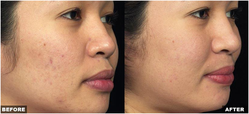 Resurfacing Laser Fraxel Dual program