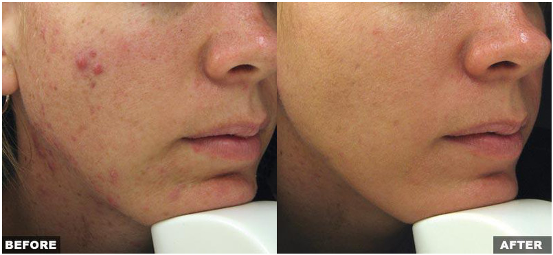 Resurfacing Laser Fraxel Dual program