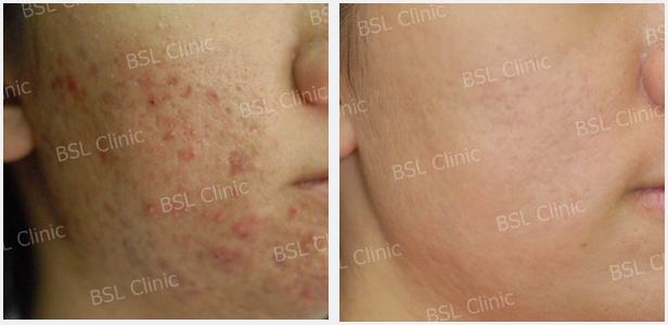 Galleries Acne Cure & Treatment, Acne Scar, Acne Blemish