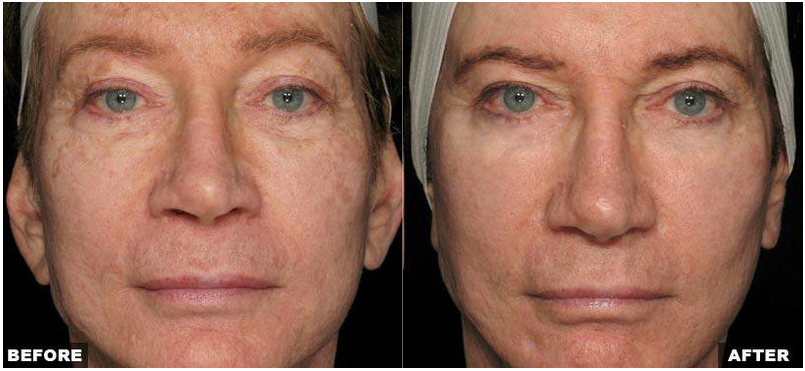 Resurfacing Laser Fraxel Dual program