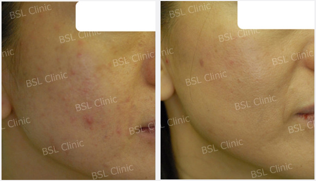 Galleries Acne Cure & Treatment, Acne Scar, Acne Blemish