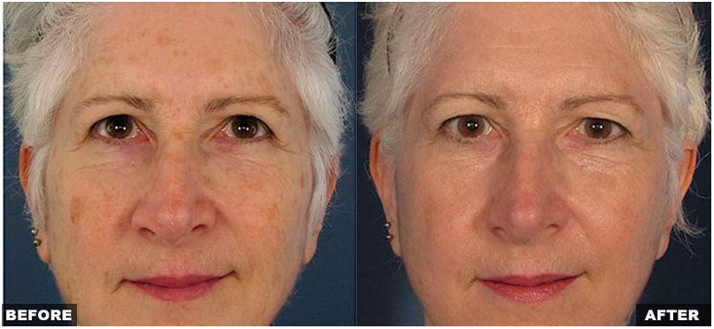 Resurfacing Laser Fraxel Dual program