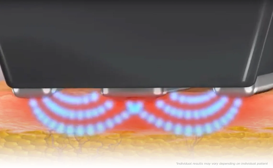 Skin Tightening Forma how it work