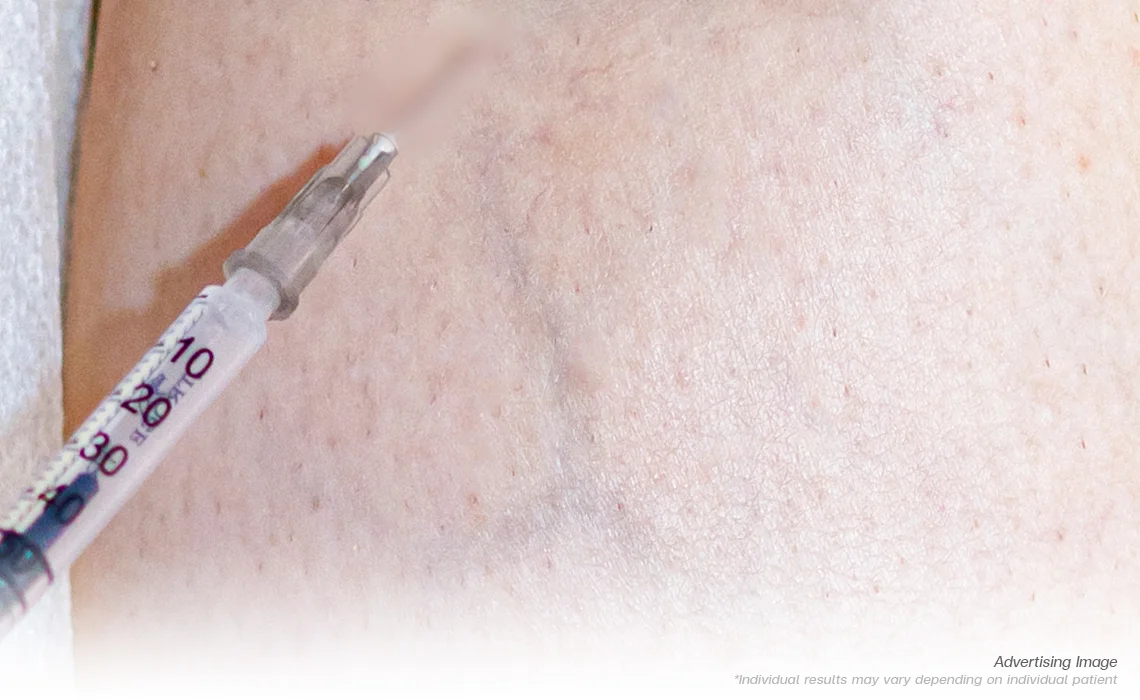 Spider and Varicose Veins Sclerotherapy