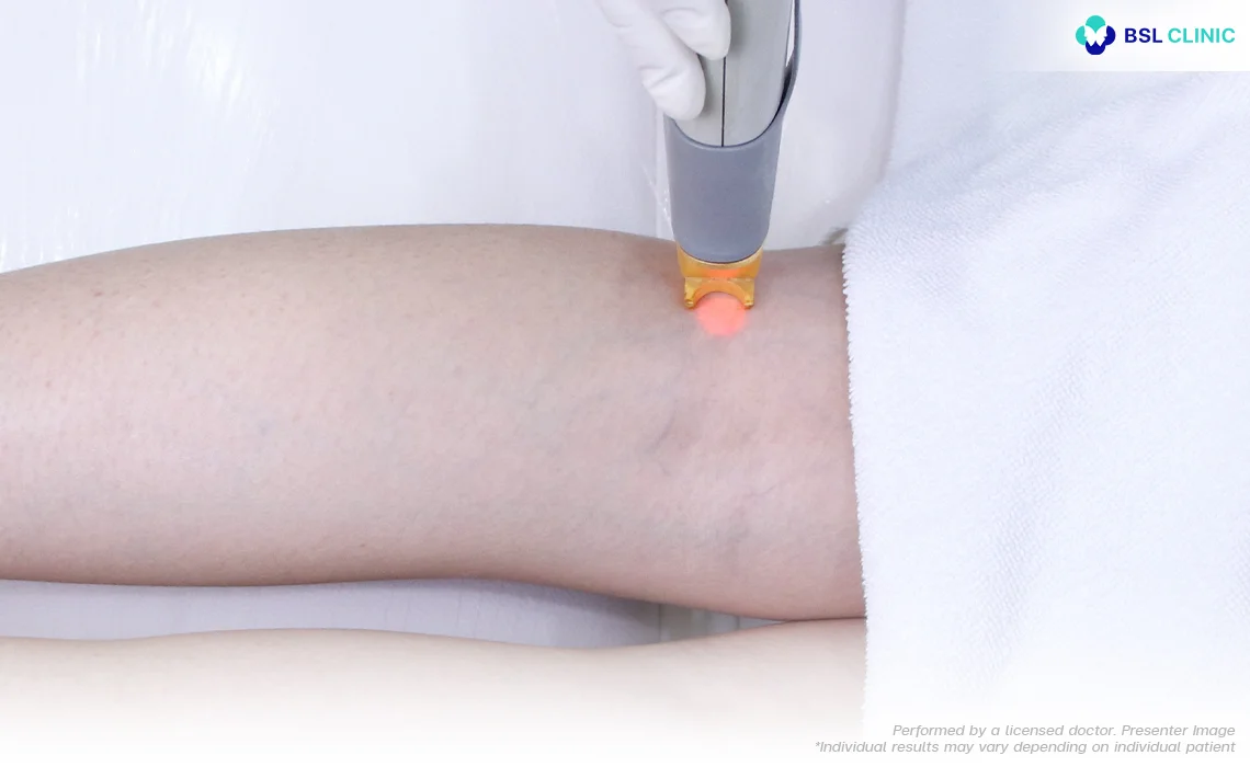 Spider and Varicose Veins Vascular Laser