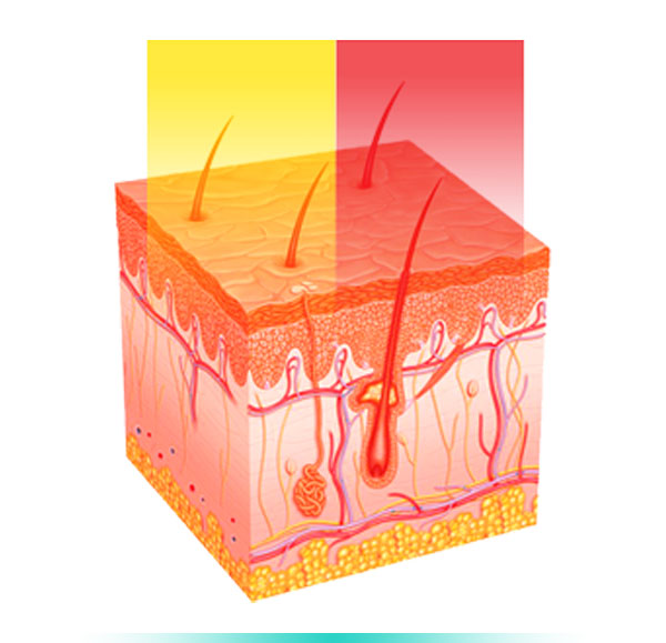 Steps in the Treatment of Sensitive Skin