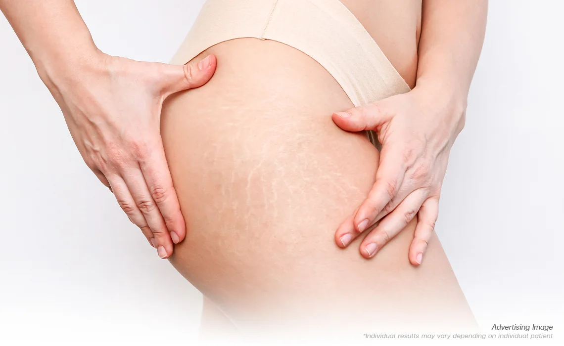 Stretch Marks and Saggy Skin
