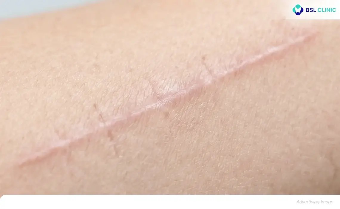Surgical and Traumatic Scars