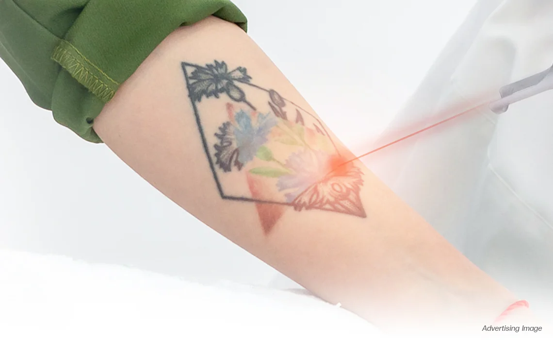 Tattoo Removal