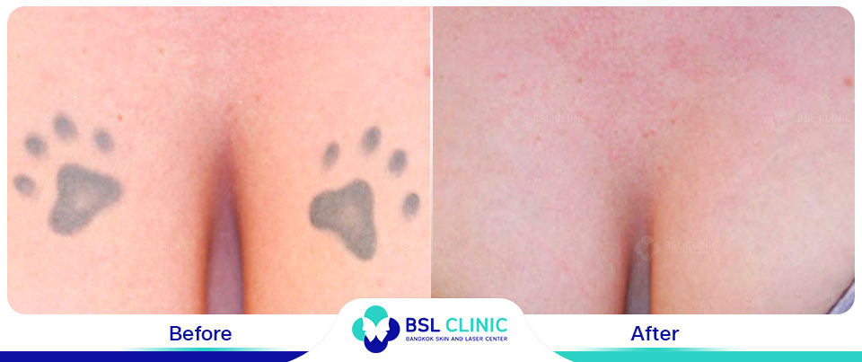 The results tattoo removal Asclepion Q Switched Ruby Laser