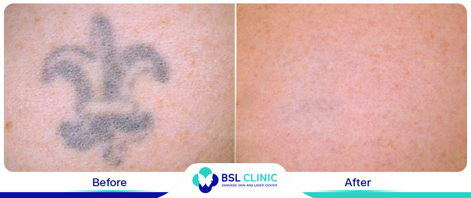 The results tattoo removal Asclepion Q Switched Ruby Laser