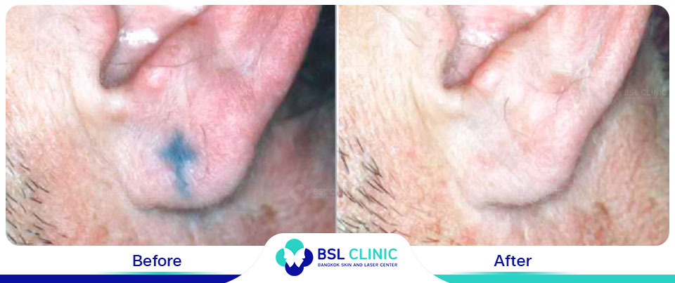 The results tattoo removal Asclepion Q Switched Ruby Laser