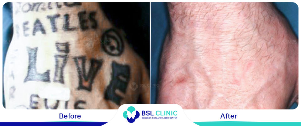 The results tattoo removal Asclepion Q Switched Ruby Laser